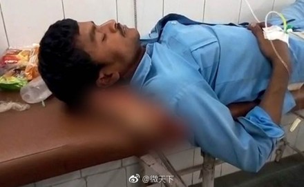 印度医院涉嫌用伤员断腿当枕头 几名涉事者被停职处理
