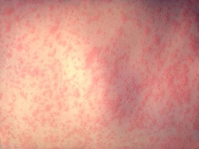 美国纽约州发布疫情警告 麻疹传染性较强需特别注意