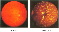 分享4年经历，华络倍睛彩低频护眼仪帮我甩掉飞蚊症