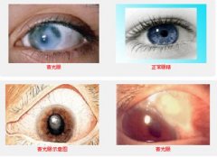 我用华络倍睛彩低频护眼仪治好偷走视力的青光眼